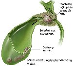 soi-tui-mat